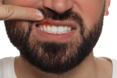 close up of adult man with inflamed gums